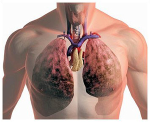 Туберкулез легких - способы лечение с помощью ксилорода